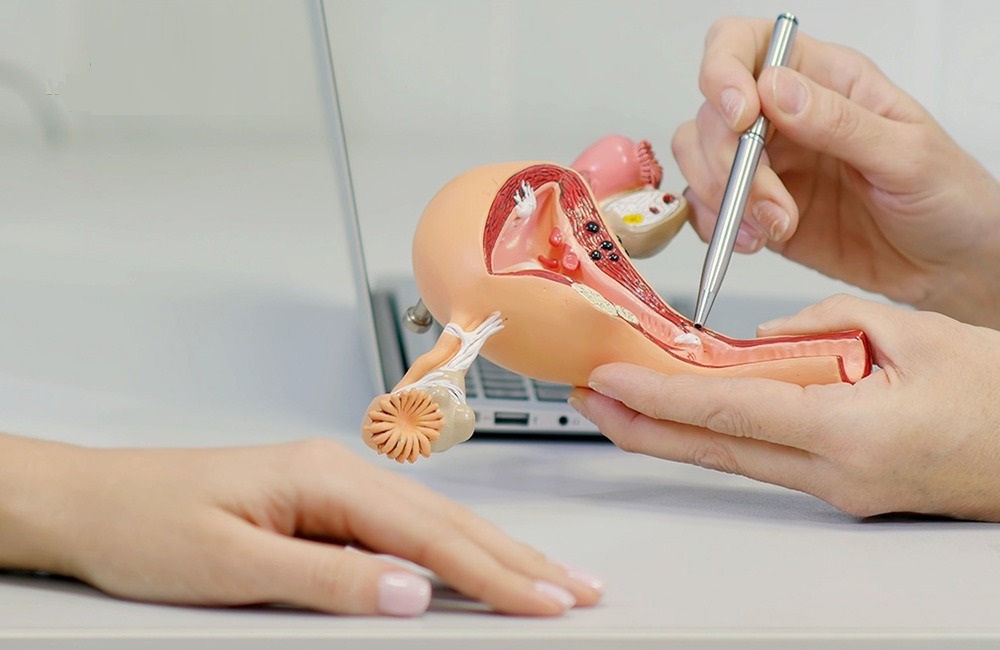 درمان فیبروم با طب سنتی