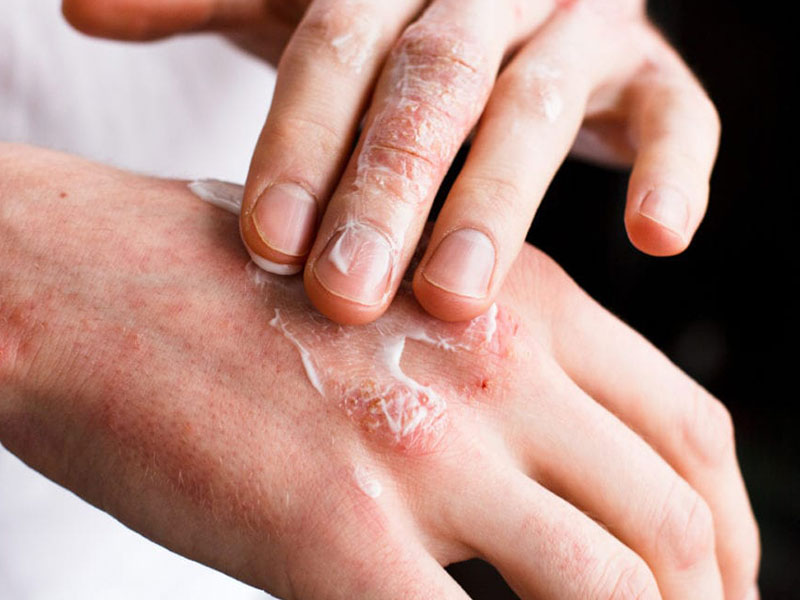 درمان قطعی پسوریازیس